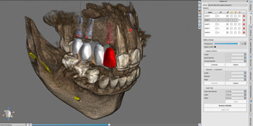 Dental implants 3D scan - single view
